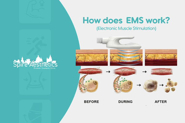 EMS treatment for post pregnancy weight loss treatment Newbury