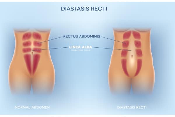 What Non-Surgical Options Are Available for Diastasis Recti Newbury?