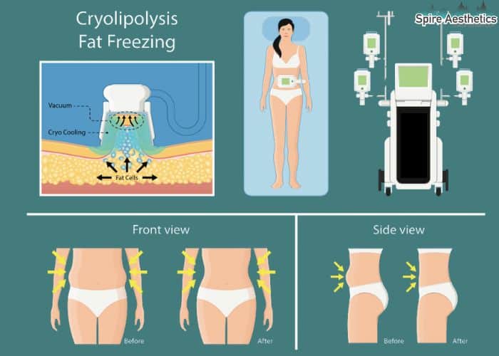 Image of diet and fat freezing combined for best results for Spire Aesthetics Newbury