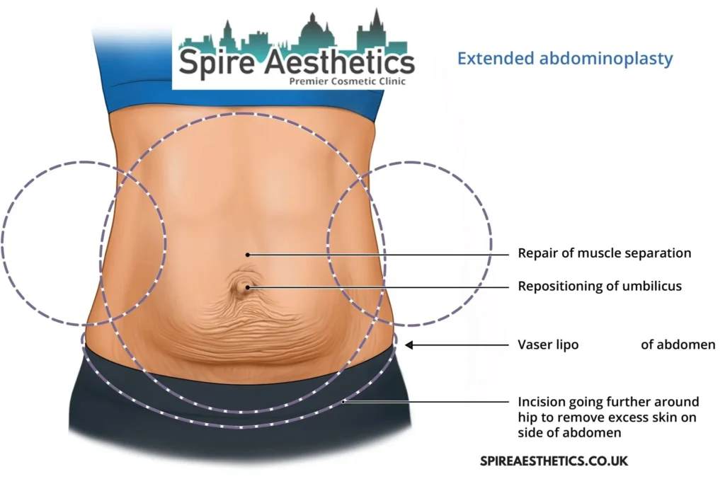 Understanding Loose Skin After Gastric Band Newbury Surgery and HIFU Treatment
