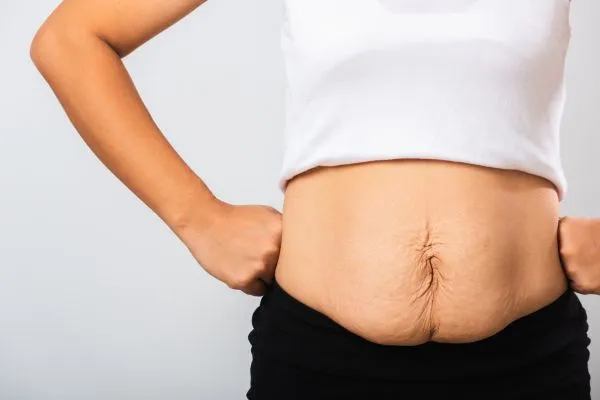 Image of a woman's stomach after weight loss with sagging skin following a gastric band Newbury