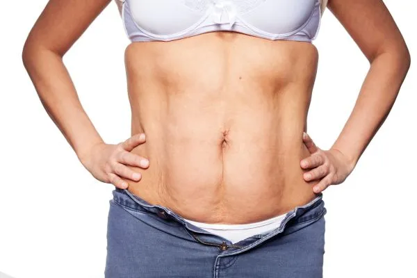 sagging skin on woman's stomach after weight loss injections Newbury