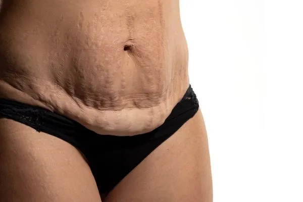 Image of womans stomach after weight loss injections Newbury showing saggy skin