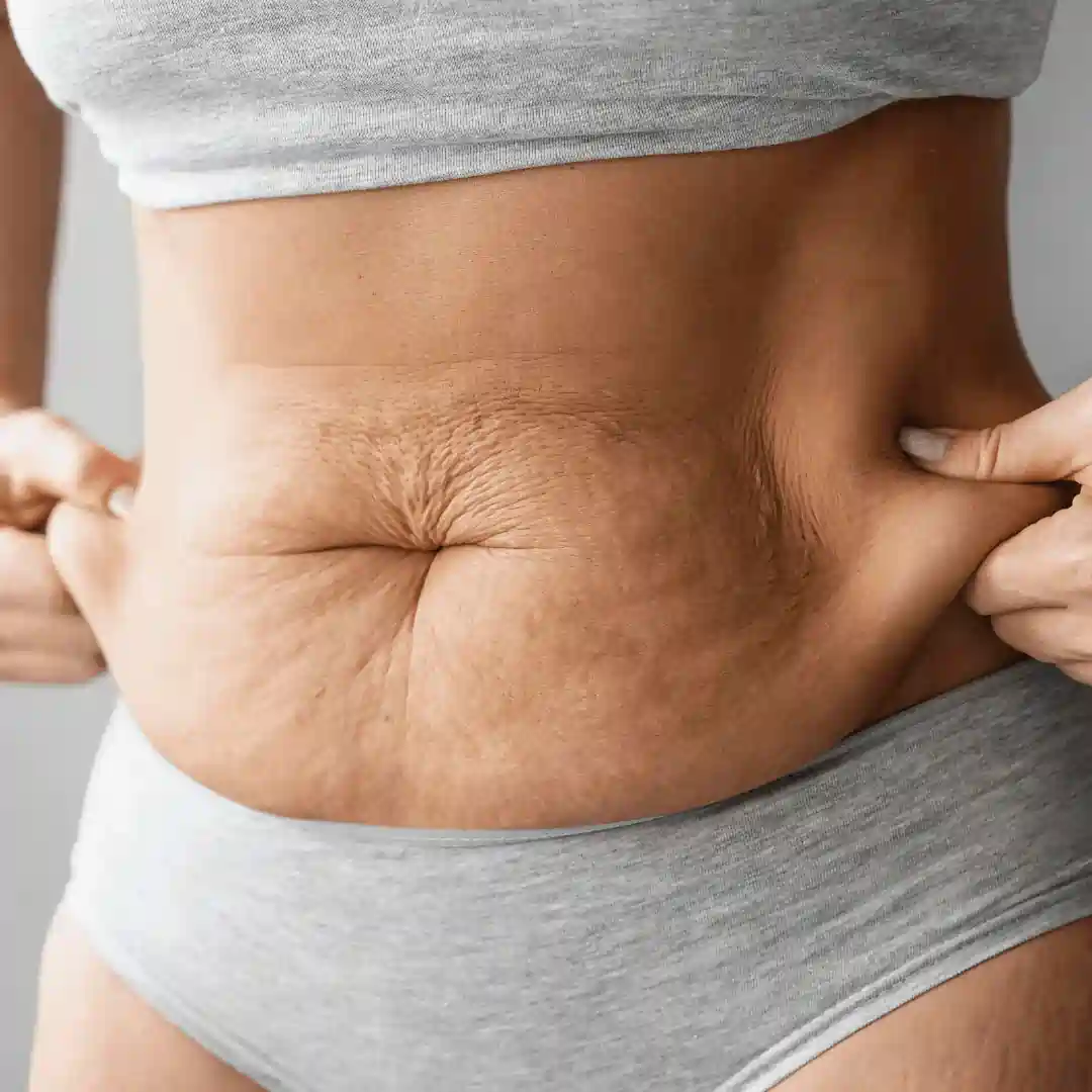 Is It Normal to Have Loose Skin After Pregnancy Newbury?