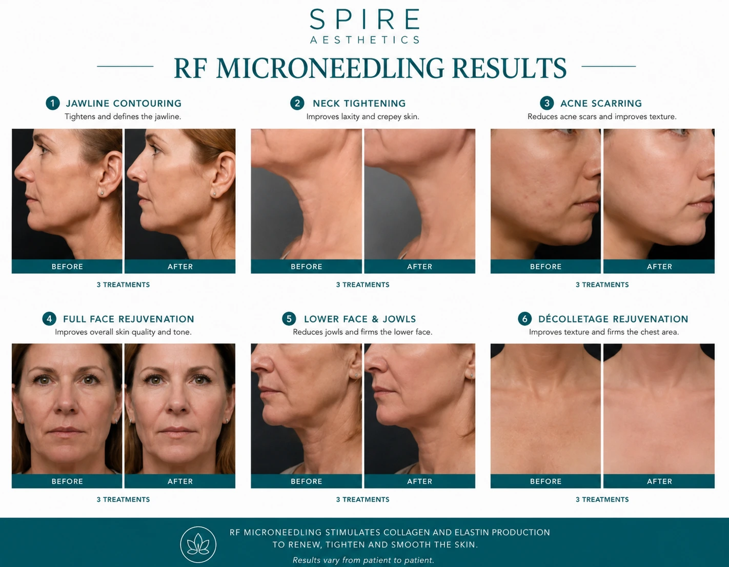 RF Microneedling Skin tightening Newbury results