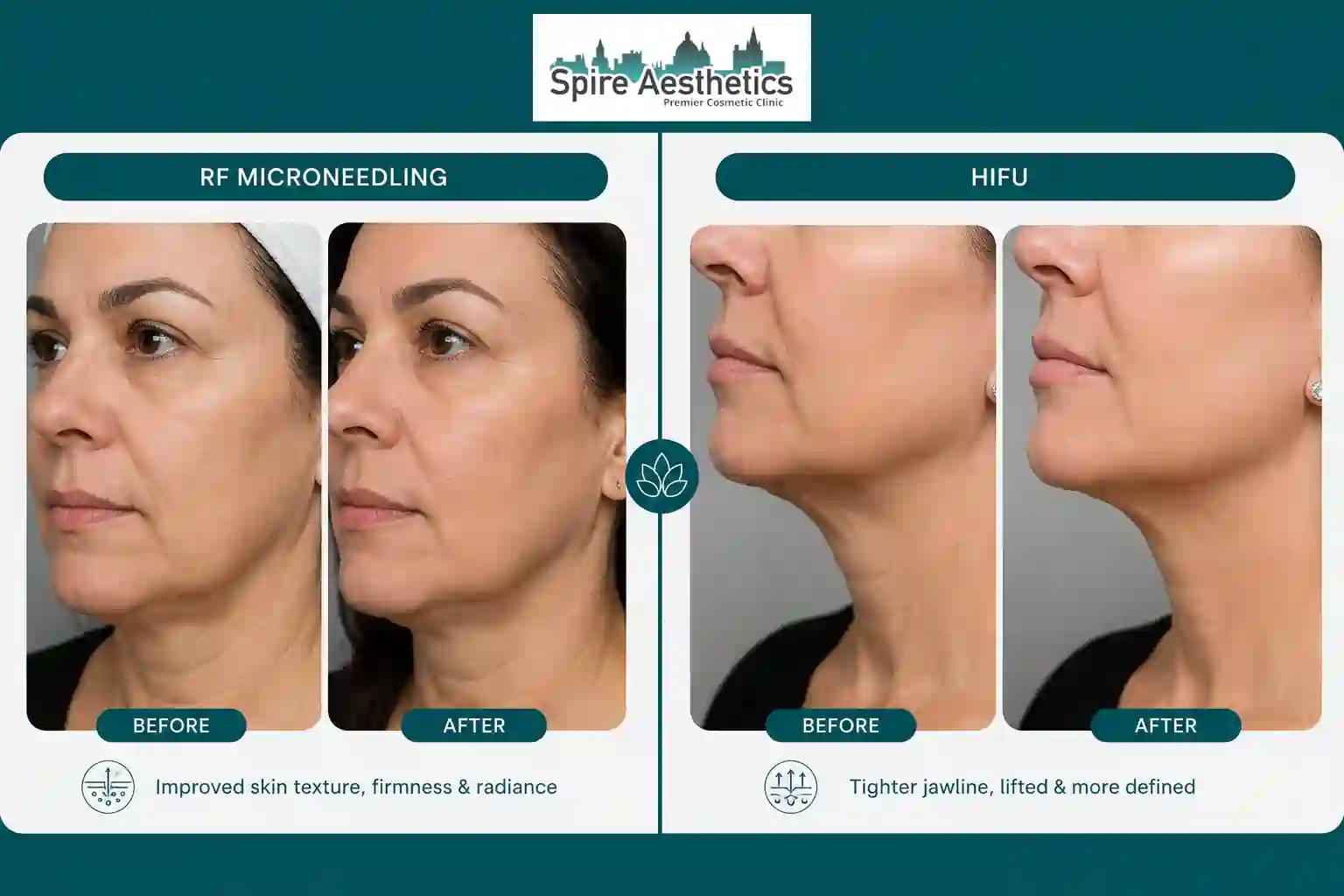Can RF Microneedling and HIFU Be Combined Newbury?