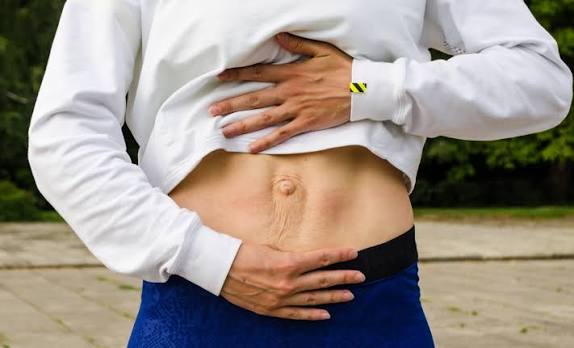When Could Diastasis Recti Be the Missing Piece of the Puzzle Newbury?