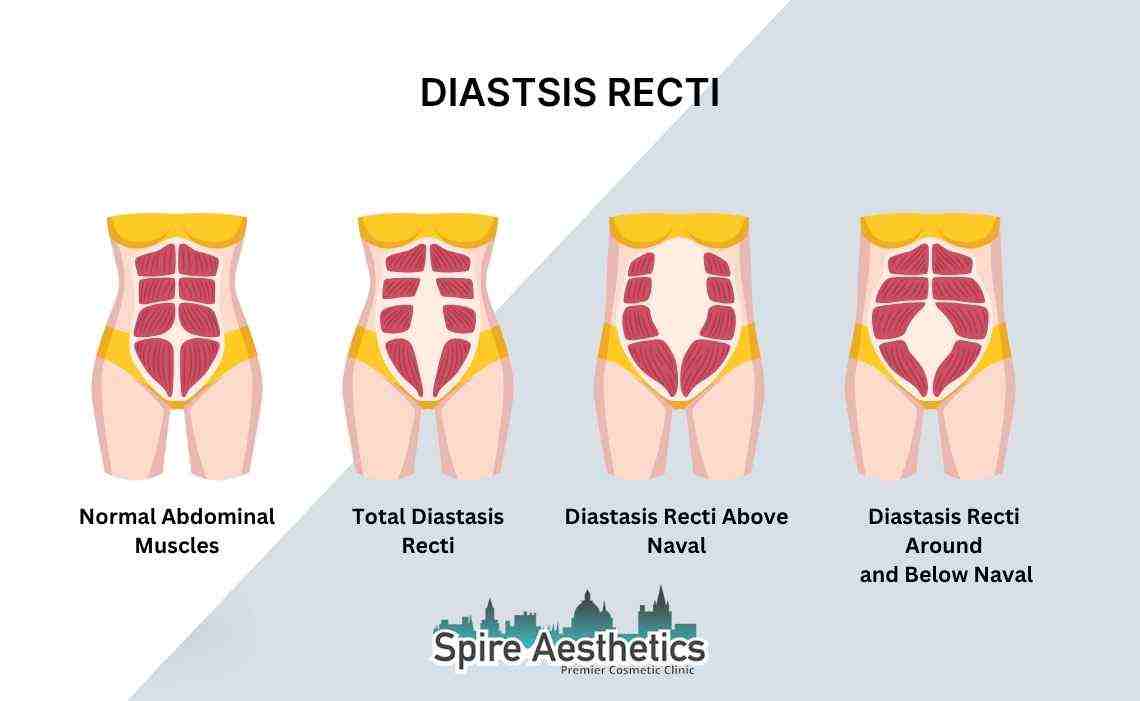 Is Non-Surgical Diastasis Recti Treatment Right for You? Common Concerns Answered Newbury